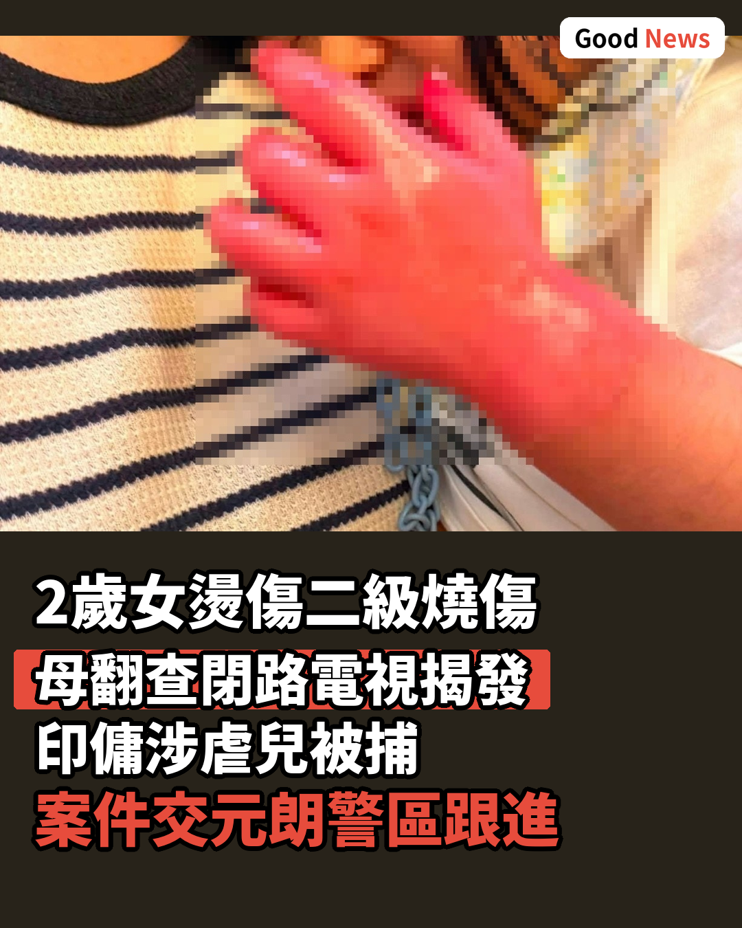 2歲女燙傷二級燒傷　母控印傭涉虐兒　警拘30歲印傭